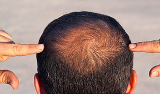 Illustration for article titled Will PRP Stop My Hair Loss?